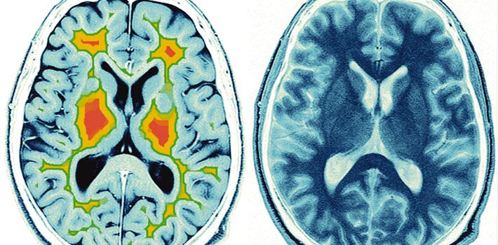 Two x-rays of brain activity.